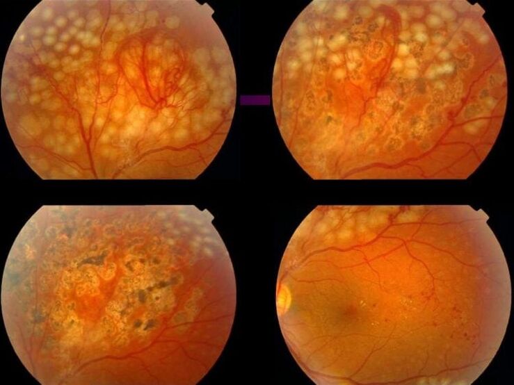 Retinopatia spôsobená hypertenziou